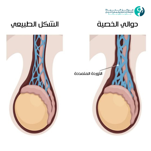 شكل دوالي الخصية